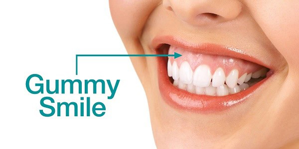 San Dentist khắc phục cười hở lợi chỉ với 5 bước