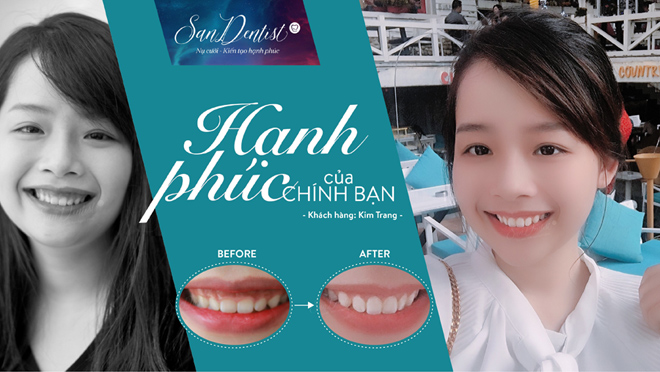 San Dentist khắc phục cười hở lợi chỉ với 5 bước