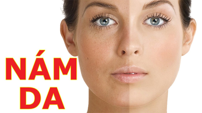 Melasma - giải pháp chăm sóc da toàn diện cho phái đẹp