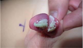 Image result for hẹp bao quy Äầu bá»nh há»c