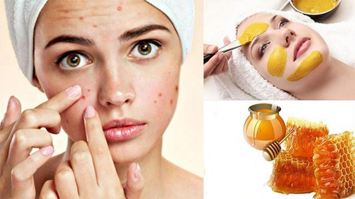 Cách trị mụn bọc sưng đỏ tại nhà an toàn