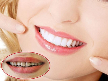Bọc răng sứ và những điều cần biết để có bộ răng trắng đẹp