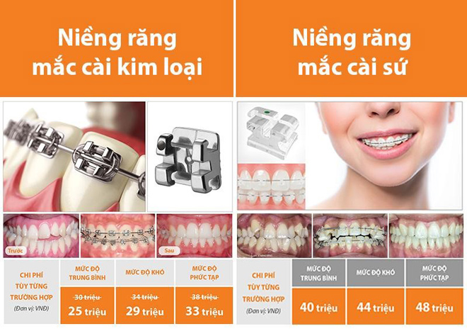 Niềng răng thẩm mỹ giá bao nhiêu? Cẩn thận tiền mất tật mang do nha khoa không uy tín