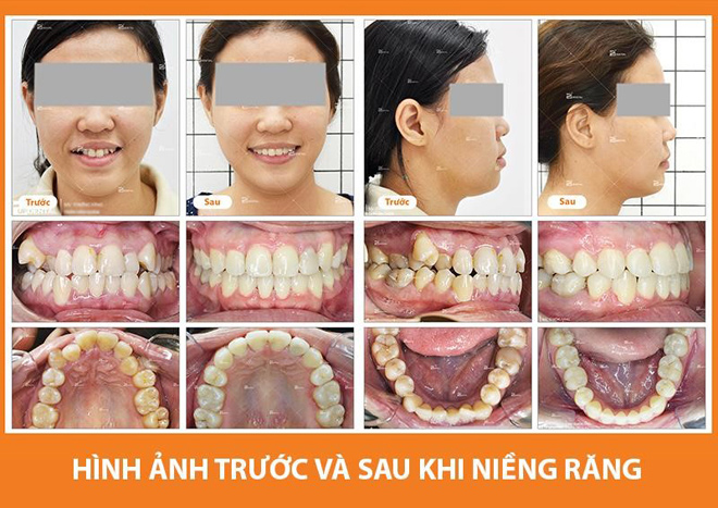 Niềng răng thẩm mỹ giá bao nhiêu? Cẩn thận tiền mất tật mang do nha khoa không uy tín