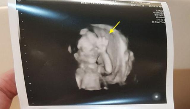 Đi siêu âm con trong bụng, hình ảnh em bé khiến bố mẹ không tin ...