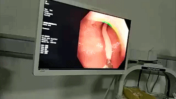 dau bung hon 10 nam, nguoi phu nu khong ngo thu nay ton tai trong co the - 1