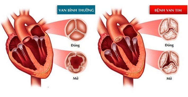 ho van tim: nguyen nhan, trieu chung va cach chua tri - 1