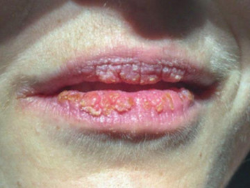 Chị em cẩn trọng khi thấy điều này trên môi, cảnh báo nguy cơ ung thư vú rất cao