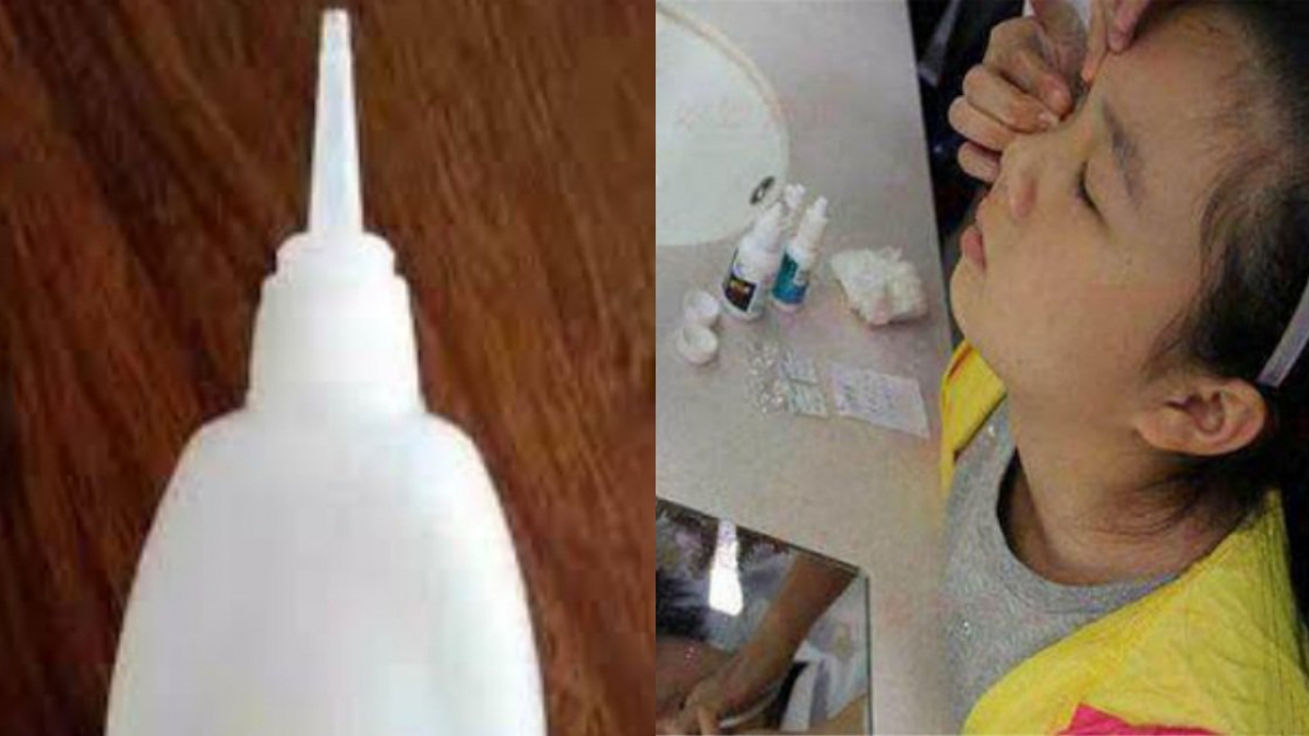 Mắt Con Dính Chặt Vì Nhỏ Nhầm Keo 502, Bố Vơ Vội Lọ Nước Đổ Thêm Vào