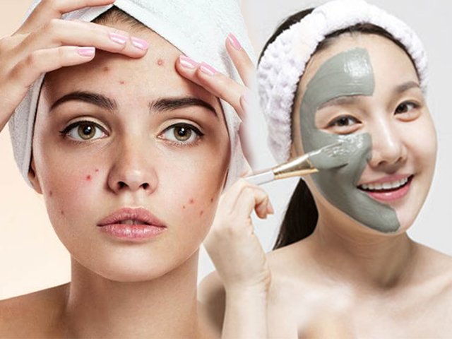 Trả lời được những câu hỏi này, nàng sẽ biết ngay loại mặt nạ trị mụn phù hợp với mình