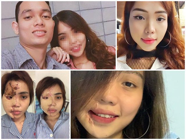 Sau hơn 1 năm, cô gái bị chồng sắp cưới là thiếu úy công an tạt axit giờ ra sao?