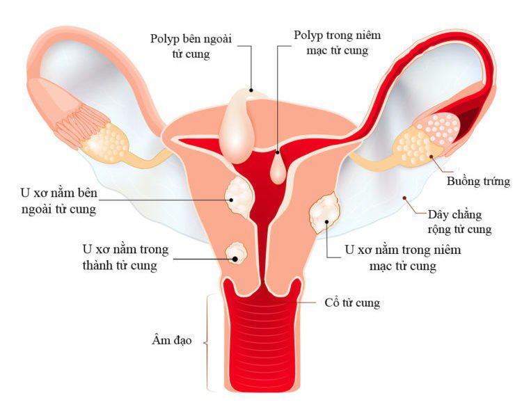 U xơ cổ tử cung có những loại nào và dấu hiệu nhận biết - 1