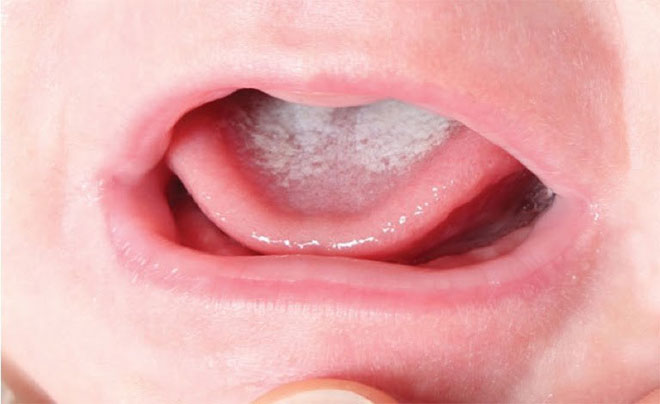 Bí quyết đánh bay tưa lưỡi ở trẻ sơ sinh
