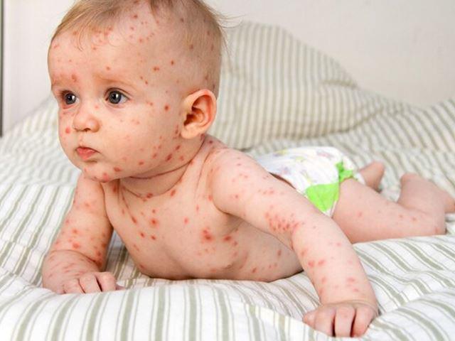 Bệnh Sởi: Tổng Hợp Nguyên Nhân, Hình Ảnh, Dấu Hiệu Và Cách Điều Trị
