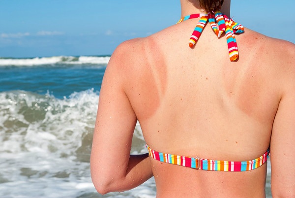 Áp dụng 5 cách chăm sóc da bị cháy nắng đơn giản giúp da lên tông nhanh chóng - 1