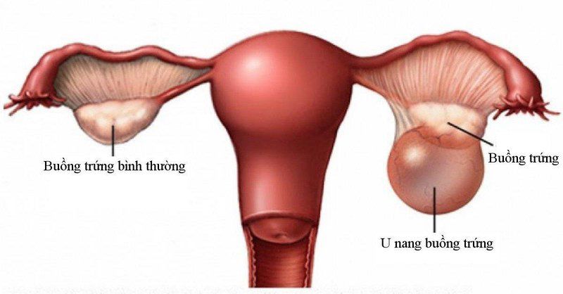 U nang buồng trứng phải: Nguyên nhân, cách điều trị và phòng ngừa - 1