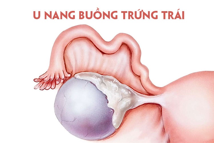 U nang buồng trứng trái: Triệu chứng, cách điều trị và những biến chứng nguy hiểm - 1
