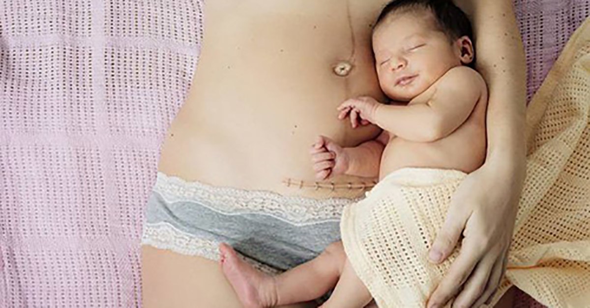 Sinh mổ lần 2 và những điều mẹ bầu cần lưu ý