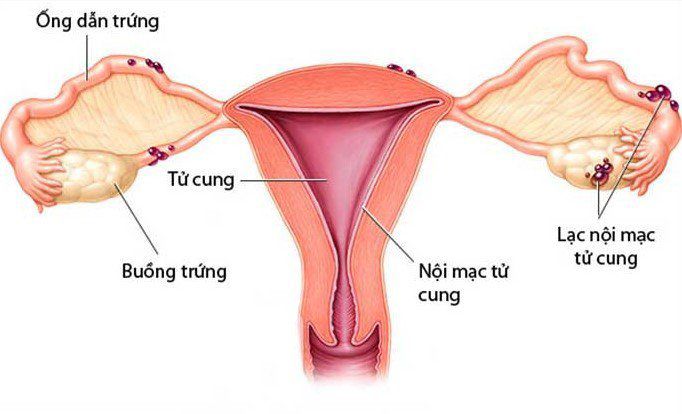 u lac noi mac tu cung: trieu chung, cach dieu tri va nhung bien chung - 1