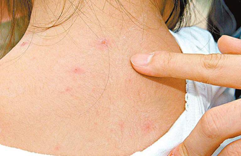 Bị thủy đậu nên ăn gì để không gặp những biến chứng nguy hiểm? - 1