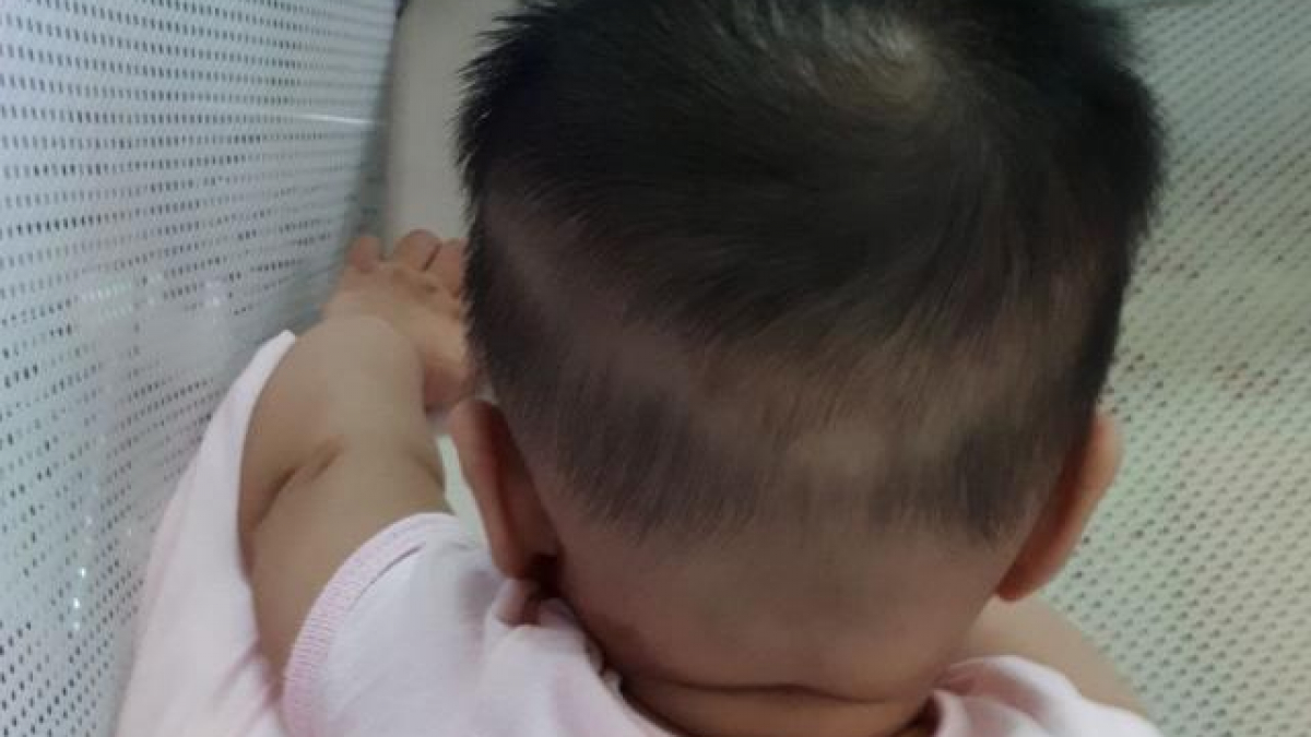 Trẻ 4 tháng tuổi rụng tóc hình vành khăn và 4 điều mẹ nên biết