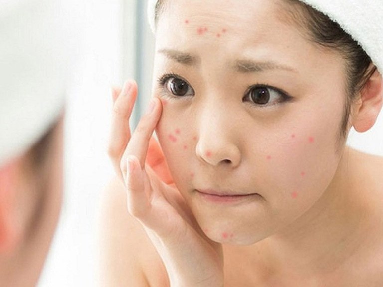 Có nên nặn mụn không? Bị mụn nên làm gì? - 1