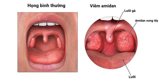 Có nên cắt amidan không? Cắt amidan có những rủi ro gì? - 1