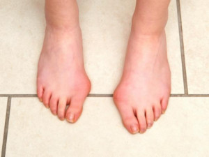 Bàn chân có những dấu hiệu này cẩn thận mắc tiểu đường hoặc bệnh tim