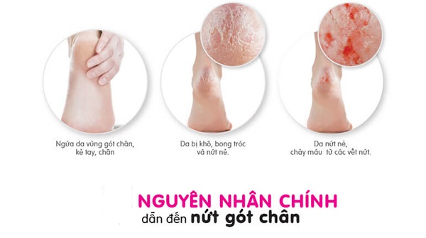 10 Cách trị nứt gót chân tại nhà tự nhiên an toàn hiệu quả nhanh nhất