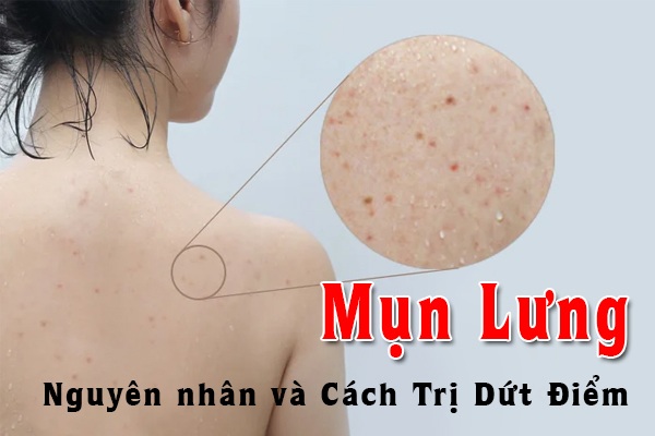 12 cách trị mụn lưng tại nhà hiệu quả giúp bạn lấy lại vẻ gợi cảm quyến rũ