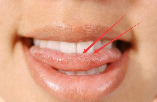 Thường xuyên cắn vào lưỡi quá nhiều có thể là dấu hiệu của đột quỵ, thậm chí ung thư - 1