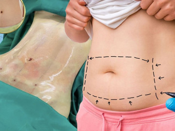 Hút mỡ tạo hình thành bụng, bí quyết vàng cho hội chị em nghiện diện bikini - Vimarsana News