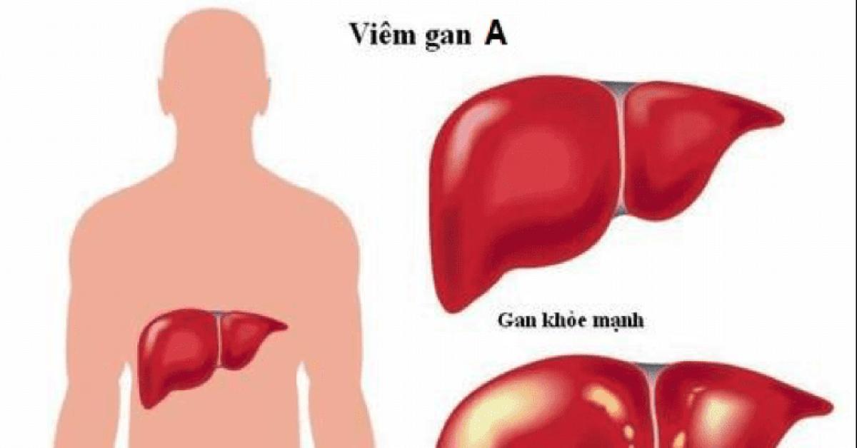 Болит печень какие. Увеличена печень болит. Увеличение печени гифка. Увеличение печени 1 сторон.