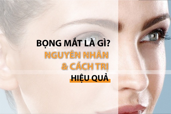 10 Cách trị bọng mắt lâu năm tại nhà hiệu quả và an toàn nhất