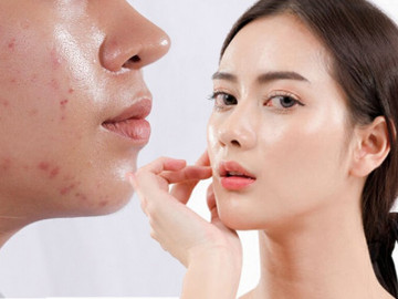Cách chọn kem chống nắng cho da dầu mụn để cuối ngày da vẫn khô ráo