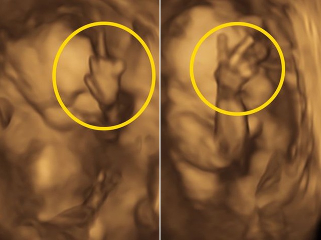 Những hình ảnh siêu âm 4D của thai nhi 25 tuần sẽ khiến quý vị cảm thấy thích thú và hồi hộp vì sự phát triển đầy kì diệu của em bé. Quý vị sẽ được chứng kiến đôi chân, tay, mặt và các cử chỉ cảm xúc của thai nhi một cách rõ ràng, sắc nét. Hãy để những hình ảnh này kết nối tình mẫu tử của quý vị và con.