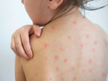 Trẻ bị phát ban nhưng không sốt là do đâu?
