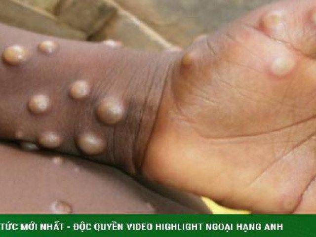 Bộ Y tế: Giám sát chặt bệnh đậu mùa khỉ trên người