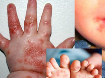Dấu hiệu bệnh chân tay miệng ở trẻ em là gì?