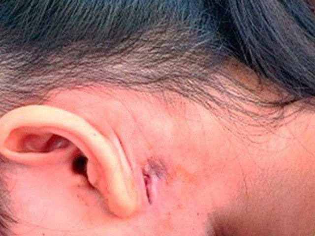 Nữ sinh ở Đắk Lắk được phát hiện mắc bệnh vi khuẩn ăn thịt người