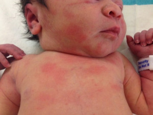 Phân biệt sốt phát ban và sốt xuất huyết ở trẻ em