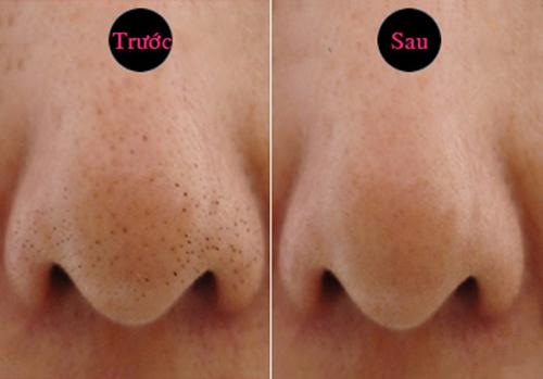 khong can nan, mun dau den van tu troi len voi 2 cach cuc don gian duoi day - 5