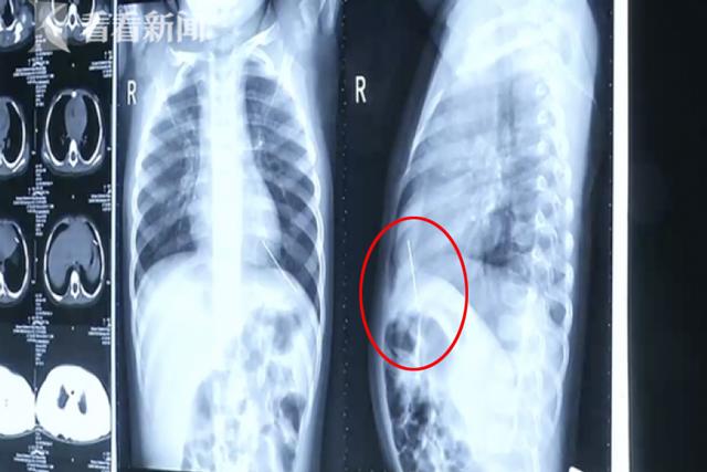 con ho khong ngung suot nhieu ngay, me dua di kham ta hoa phat hien thu kinh khung trong nguc - 2