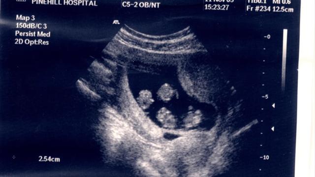 chuan bi thu tinh nhan tao thi phat hien mang thai, ket qua sieu am con bat ngo hon nua - 2