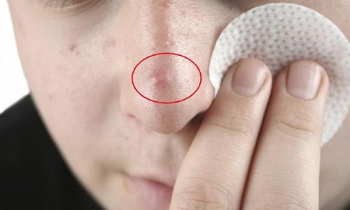 cach tri mun boc tra lai lan da cang bong, ai ma khong biet la phi ca doi! - 1