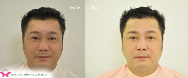 den trung tam chong lao hoa xuan hung lam dep voi gia sieu uu dai trong dip sinh nhat - 5