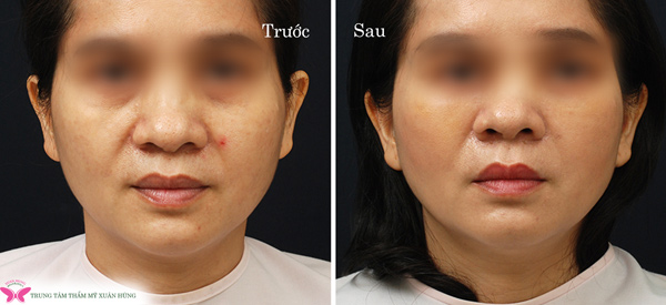 den trung tam chong lao hoa xuan hung lam dep voi gia sieu uu dai trong dip sinh nhat - 6