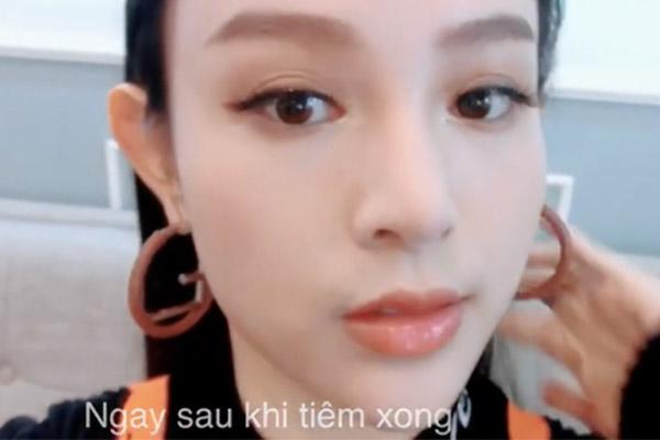 de keo dai sac xuan, me hai con huyen baby khong ngai chia se can canh tiem filler ranh moi - 6