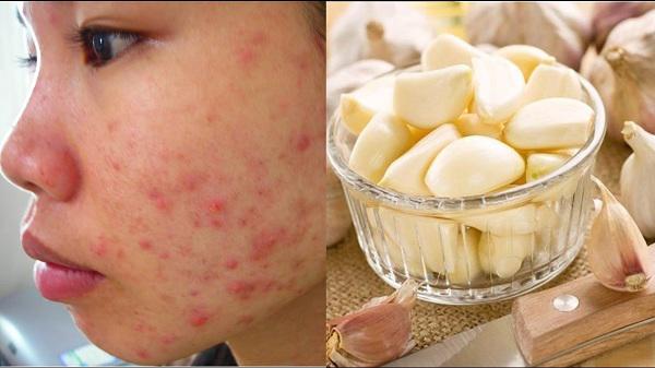 ap dung 5 cach tri mun tham 100% thien nhien de lay lai lan da cang bong, min mang - 10