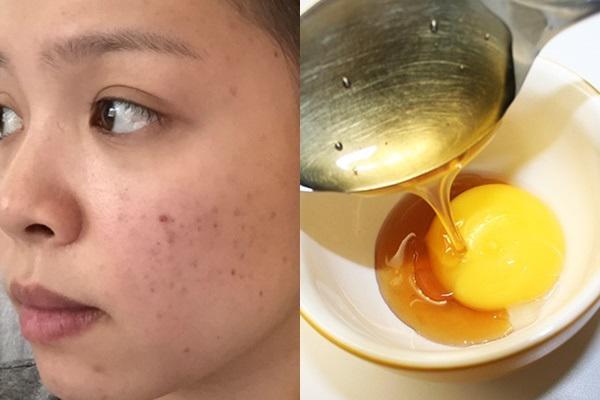 ap dung 5 cach tri mun tham 100% thien nhien de lay lai lan da cang bong, min mang - 12